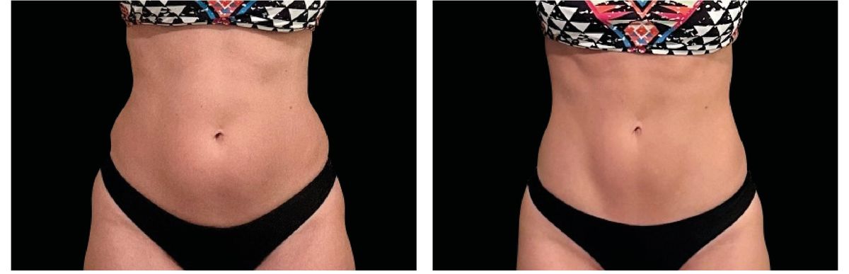Emsculpt Neo before and after 1
