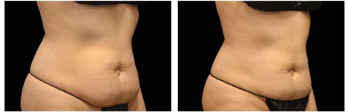 Emsculpt Neo before and after 10