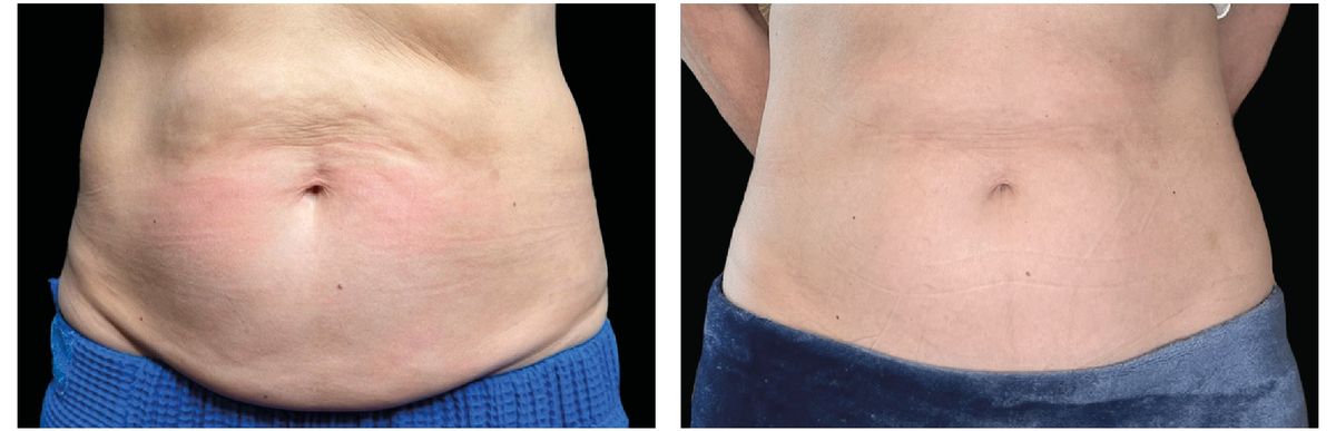 Emsculpt Neo before and after 11