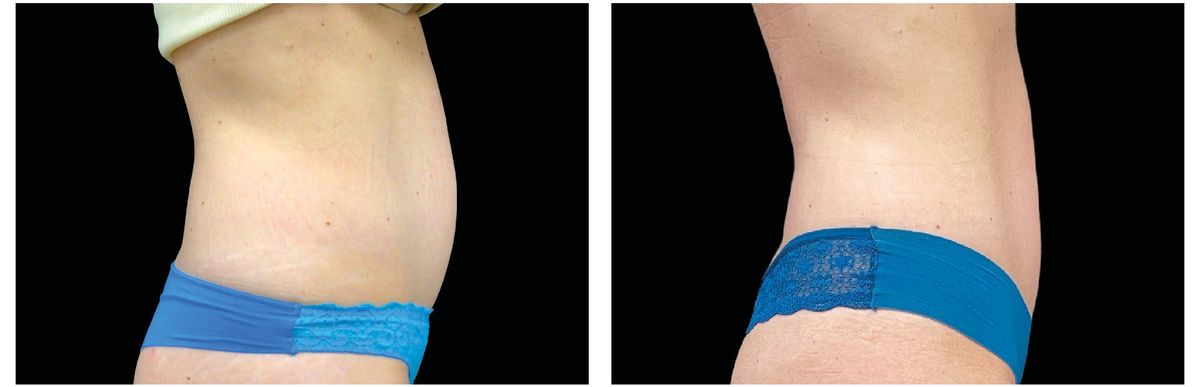 Emsculpt Neo before and after 12
