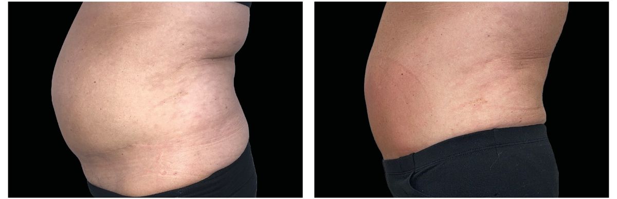 Emsculpt Neo before and after 13