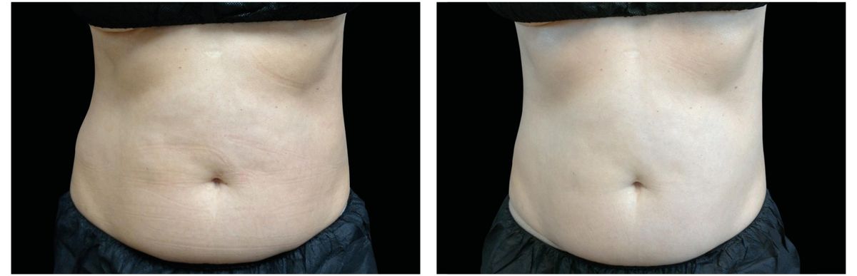 Emsculpt Neo before and after 14