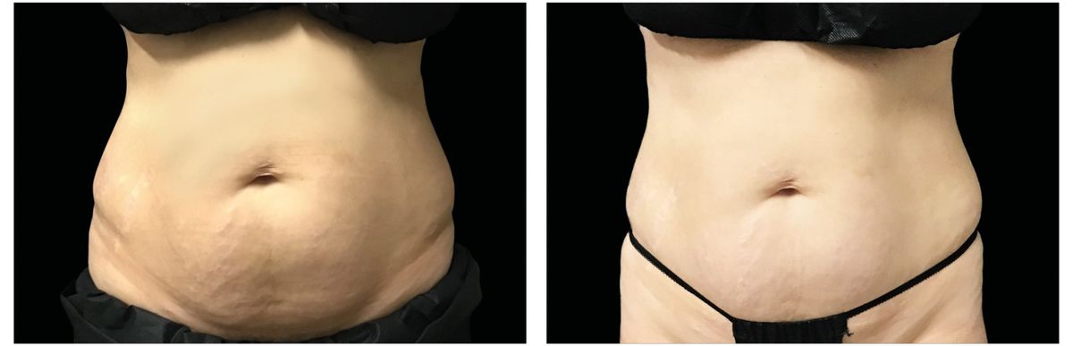 Emsculpt Neo before and after 15
