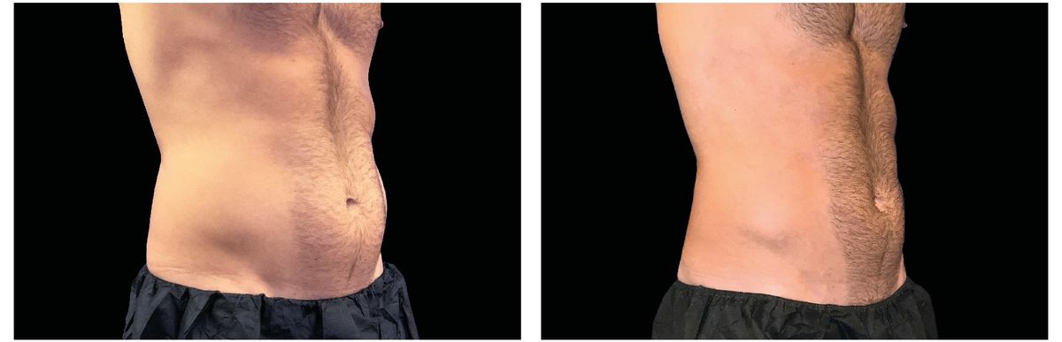 Emsculpt Neo before and after 16