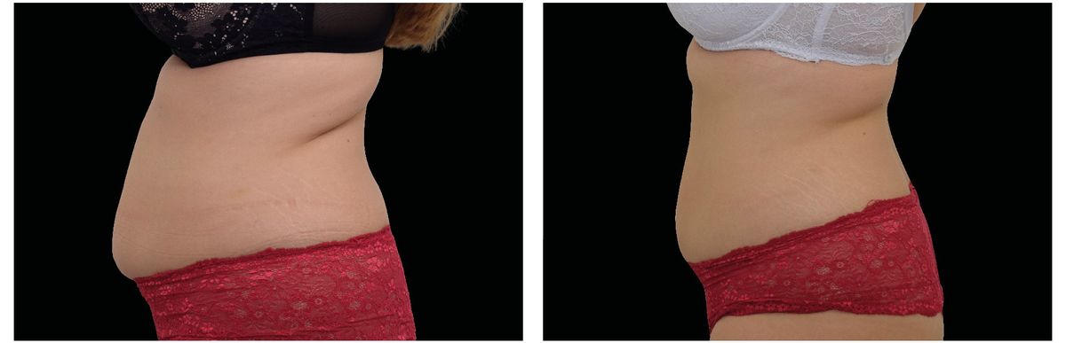 Emsculpt Neo before and after 17