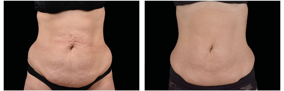 Emsculpt Neo before and after 18