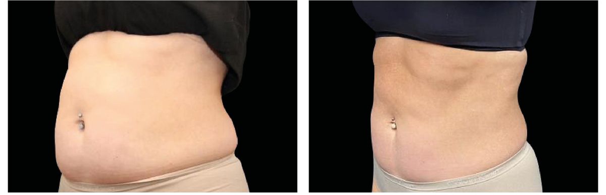 Emsculpt Neo before and after 19