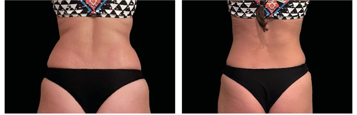 Emsculpt Neo before and after 2