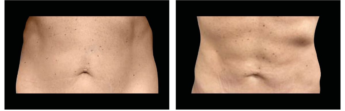 Emsculpt Neo before and after 20