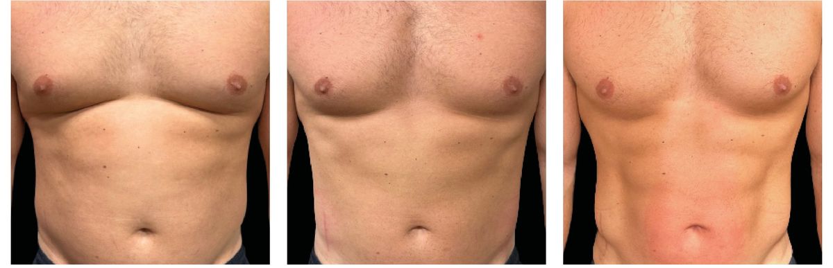 Emsculpt Neo before and after 21