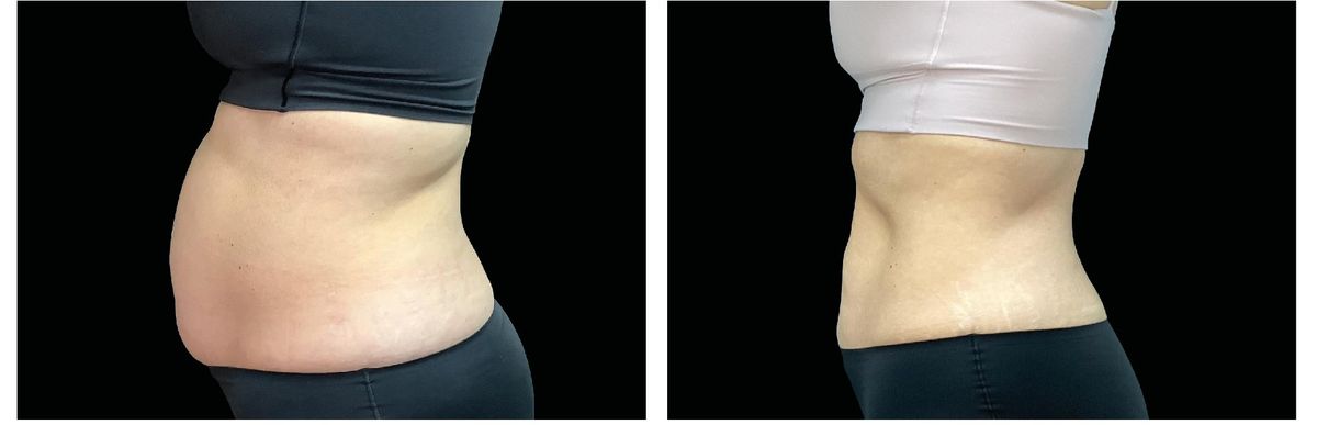 Emsculpt Neo before and after 22