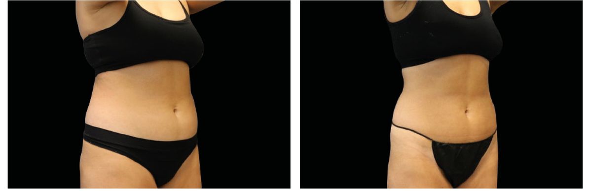 Emsculpt Neo before and after 23