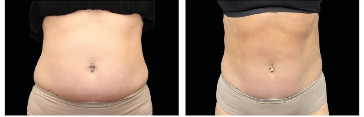 Emsculpt Neo before and after 3