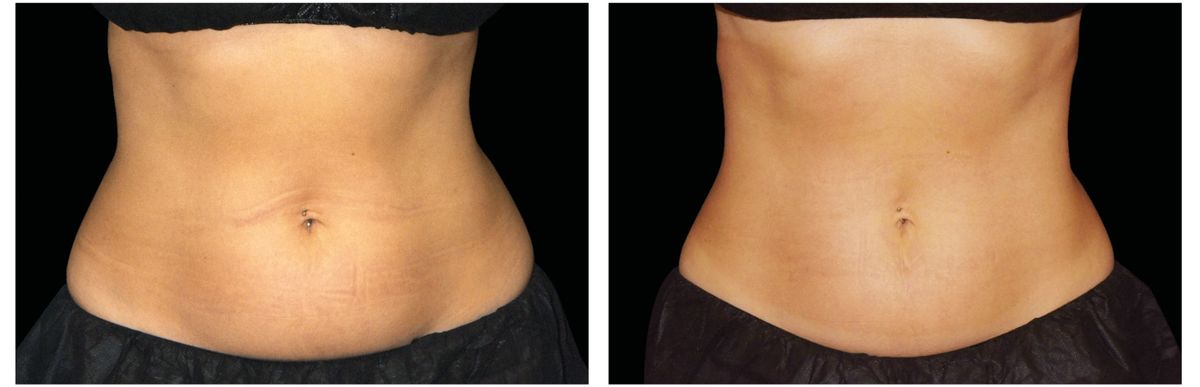 Emsculpt Neo before and after 4