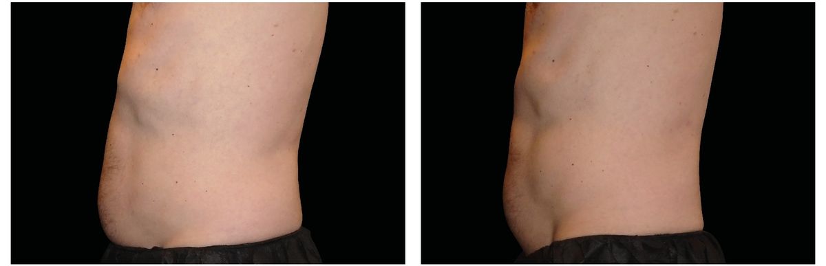 Emsculpt Neo before and after 5