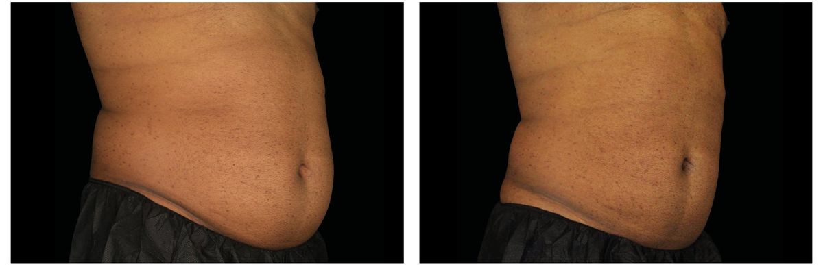 Emsculpt Neo before and after 6