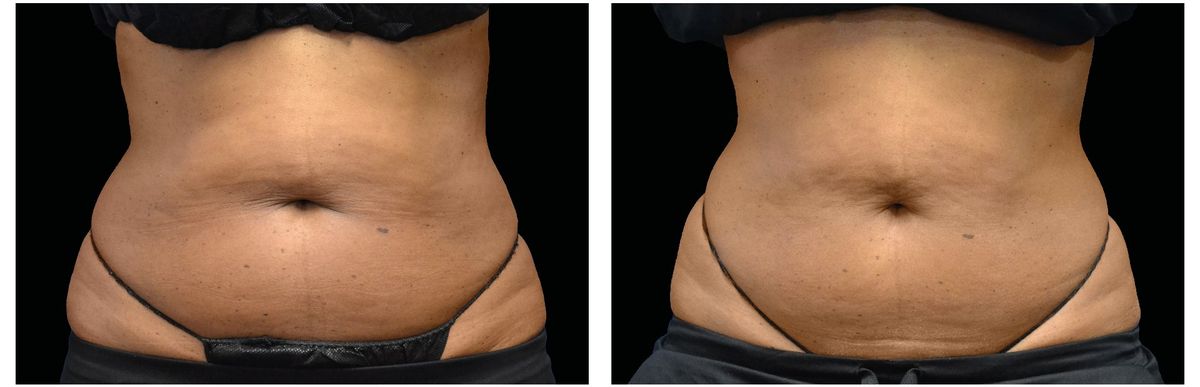 Emsculpt Neo before and after 7