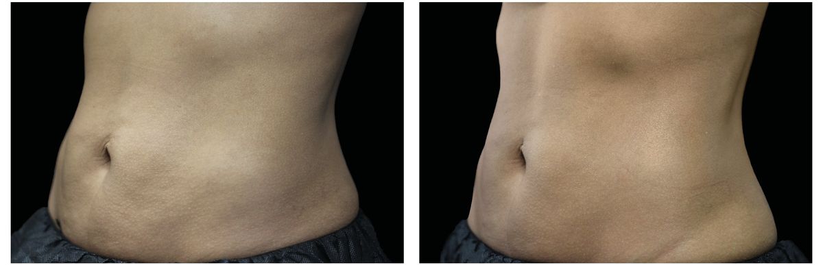 Emsculpt Neo before and after 8