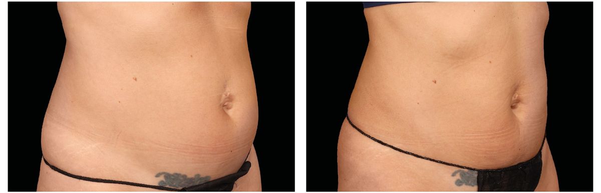 Emsculpt Neo before and after 9